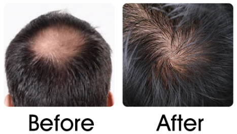 Hair Growing Laser Comb – JOOPZY