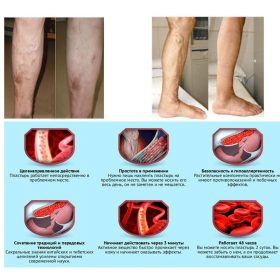 Varicose Veins Herbal Healing Patch, Varicose Veins Herbal Healing Patch