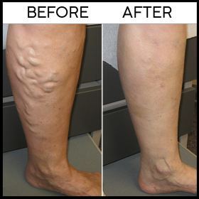 Varicose Veins Herbal Healing Patch, Varicose Veins Herbal Healing Patch