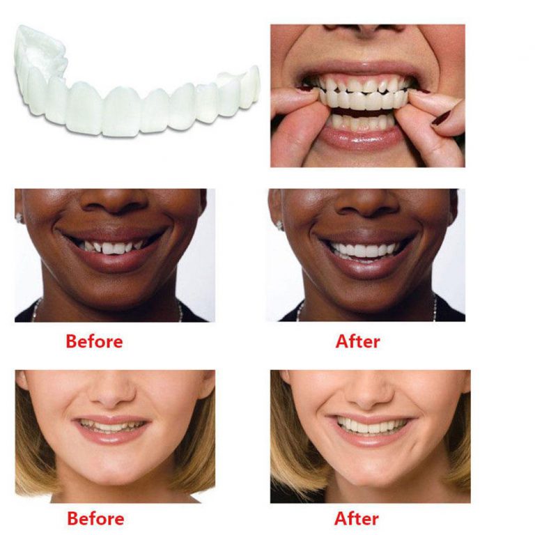 Perfect Smile Snap On Braces - Not sold in stores