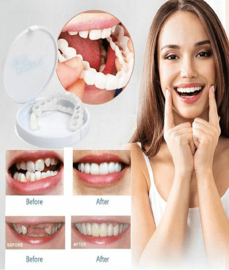 Perfect Smile Snap On Braces - Not sold in stores